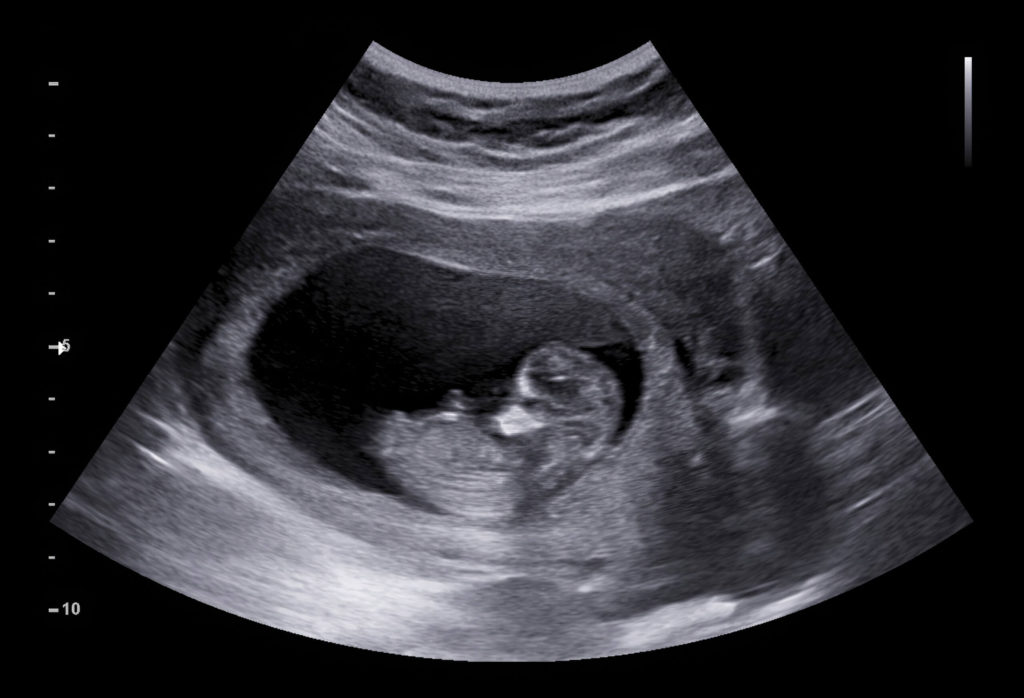 early sonogram picture